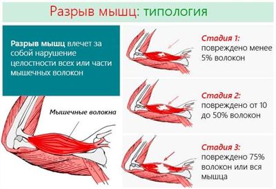 Лечение растяжения икроножной мышцы